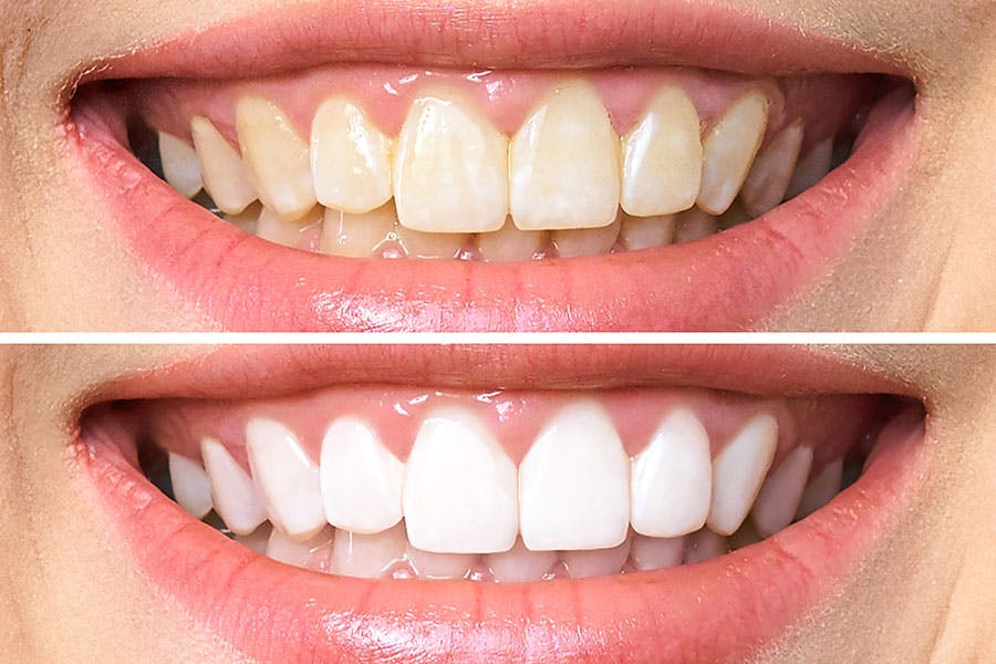 Before and After Teeth Whitening Exhibit 1