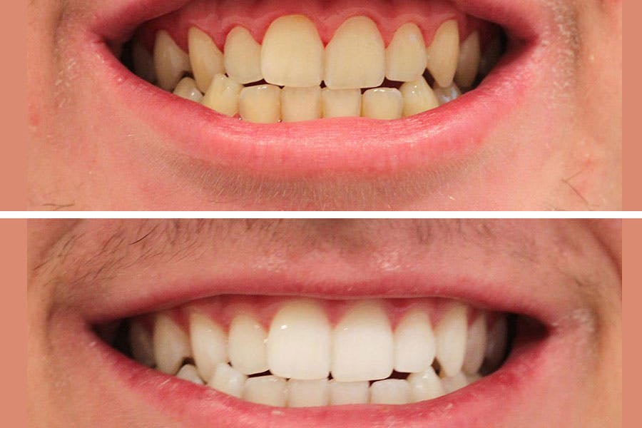 Before and After Teeth Whitening Exhibit 2
