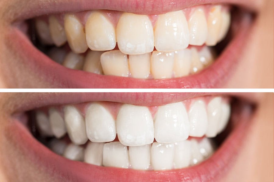 Before and After Teeth Whitening Exhibit 3