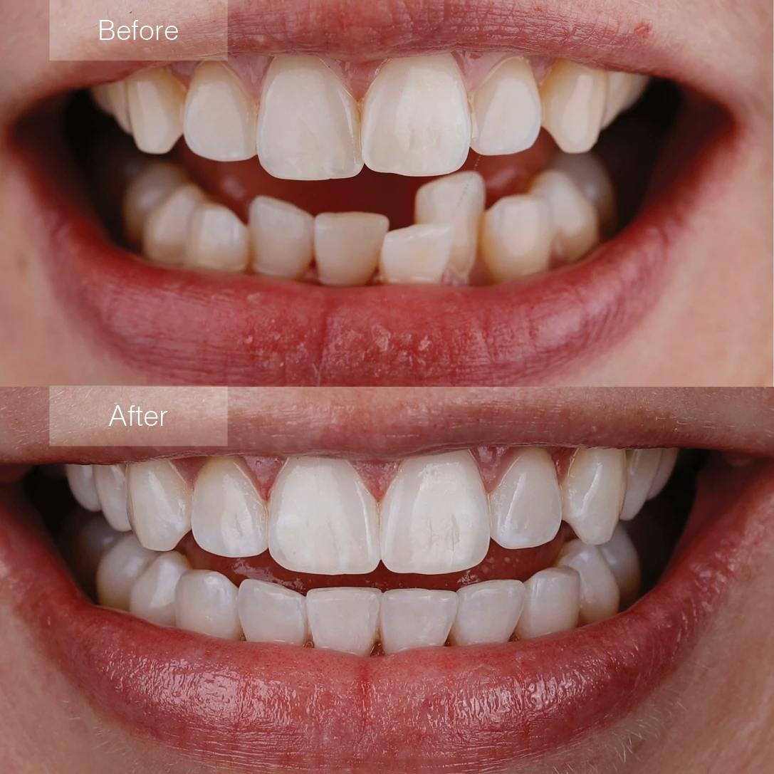 invisalign_before_after