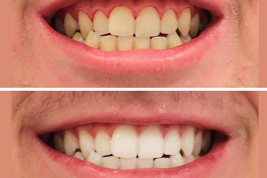 Before and After Teeth Whitening Exhibit 2