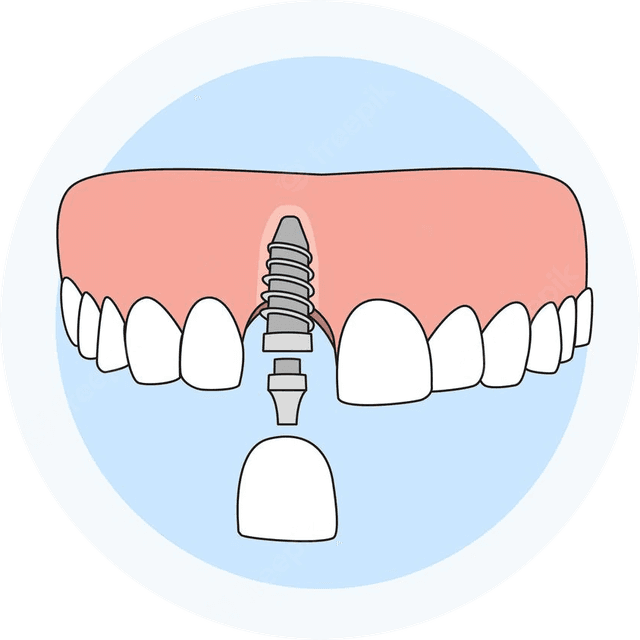 Implant Graphic